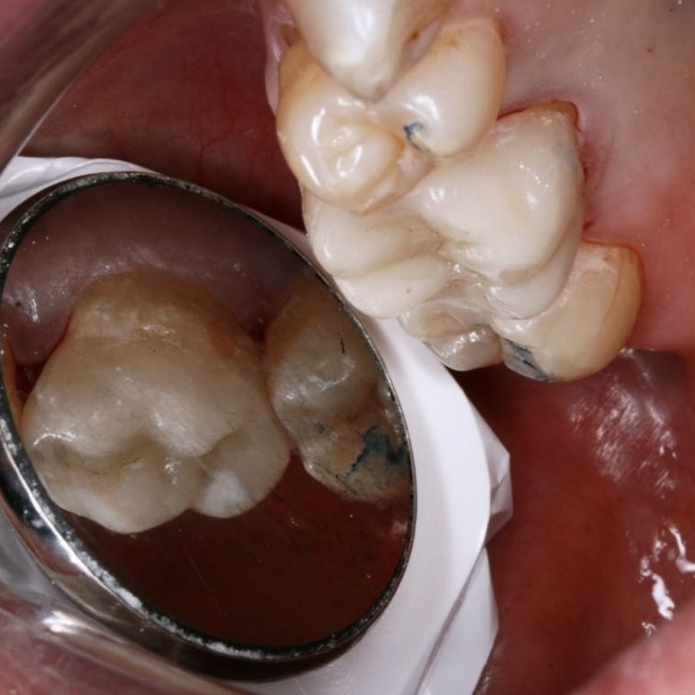 alt="digital dentistry 3D scan same day crowns invisalign Richmond NSW"