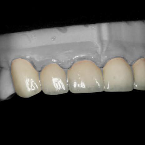 alt="same day crowns invisalign TLC dentists Richmond NSW"