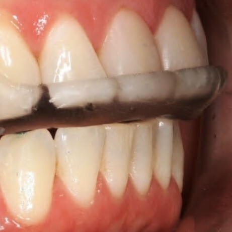 alt="TLC dentists Richmond NSW  invisalign"